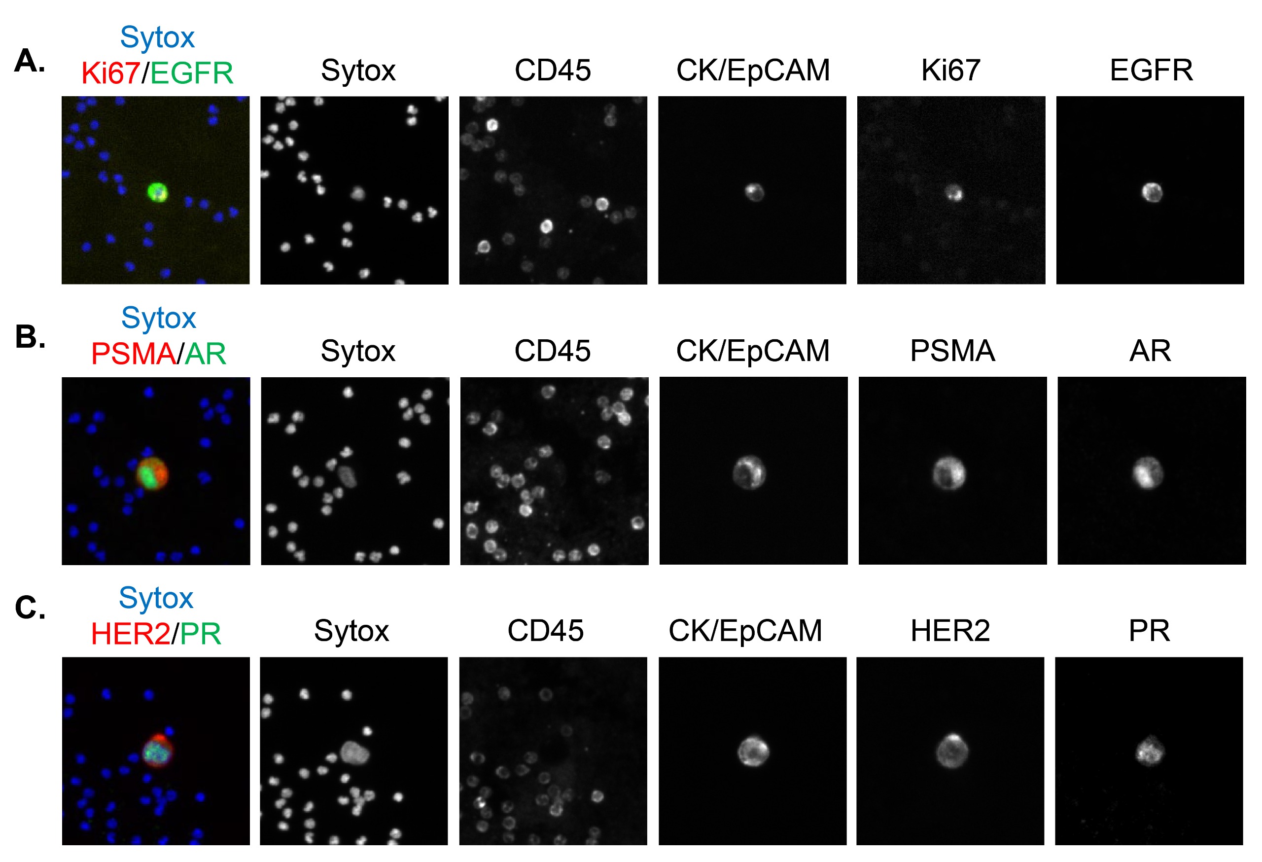  mCTCs staining with expected subcellular localization using the base epithelial CTC detection assay and two additional biomarkers.   