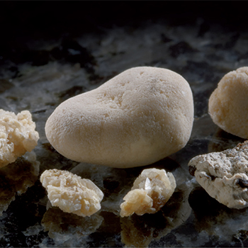 Kidney stones