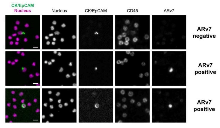 Clinical CTC stained for ARv7